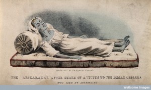 A dead victim of cholera at Sunderland in 1832. Coloured lit